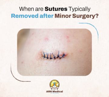 When are Sutures Typically Removed after Minor Surgery?